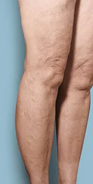 After treatment &mdash; Lower leg & ankle veins