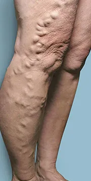 Before treatment &mdash; Lower leg & ankle veins