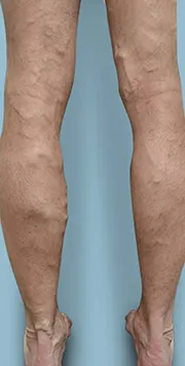 After treatment &mdash; Calf cluster reduction