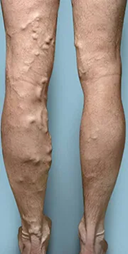 Before treatment &mdash; Calf cluster reduction