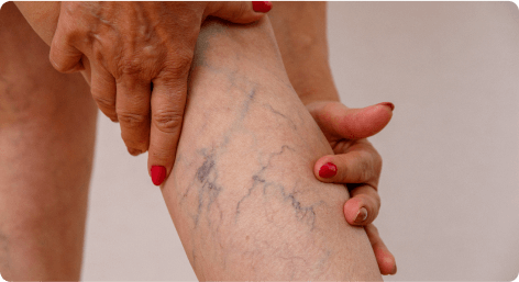 Advanced Medical Group spider vein