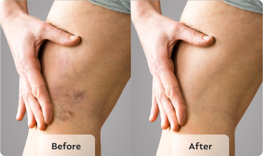 before and after varicose vein surgery