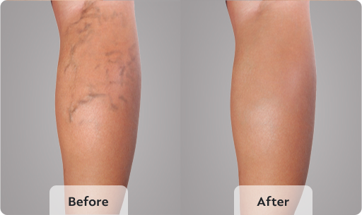 before and after varicose vein treatment