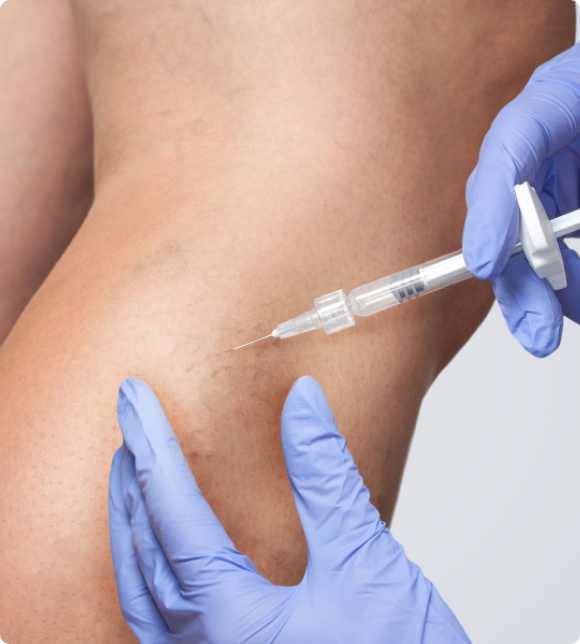 sclerotherapy clinic