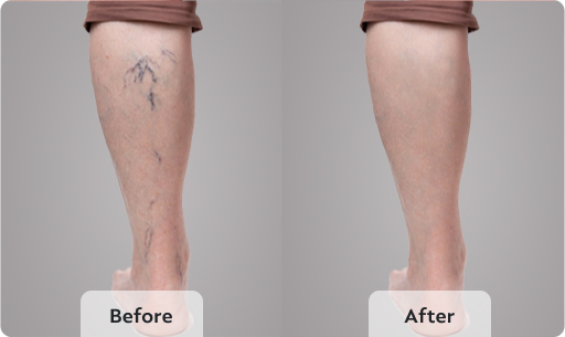varicose vein removal before and after