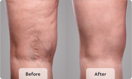 varicose vein treatment before and after
