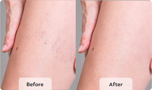 varicose vein treatment before and after