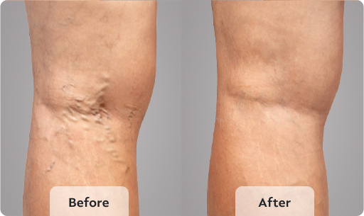 varicose veins before and after