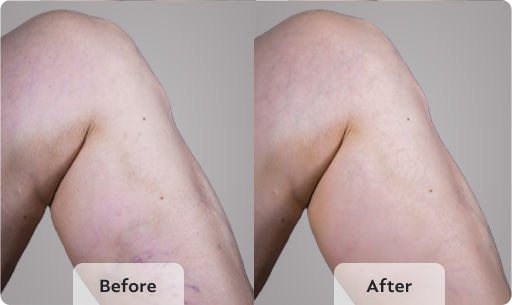 varicose veins pictures before and after