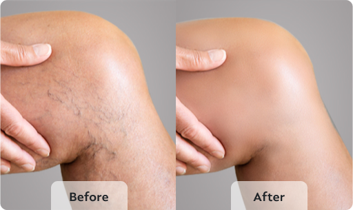 varicose veins surgery before and after
