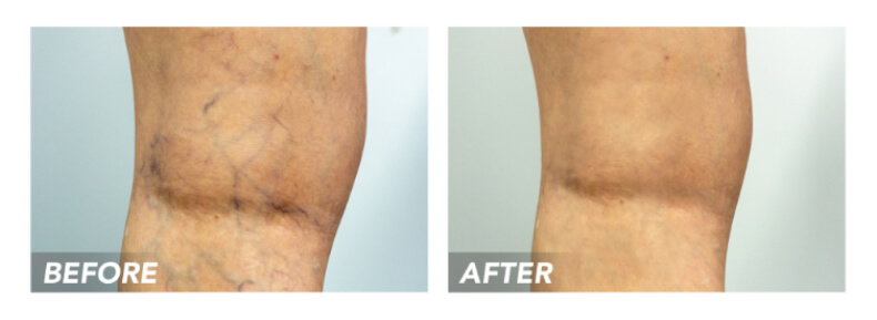 Before after spider veins legs