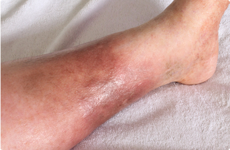 venous insufficiency treatment
