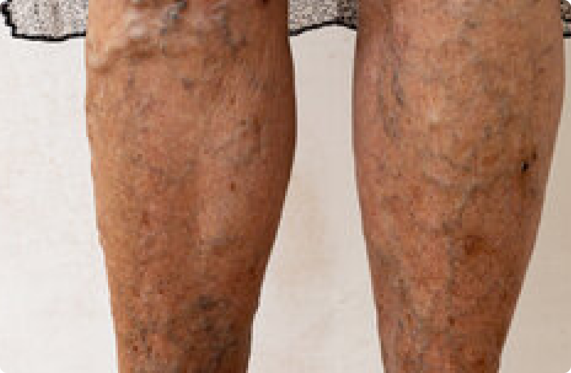 Peripheral Artery Disease