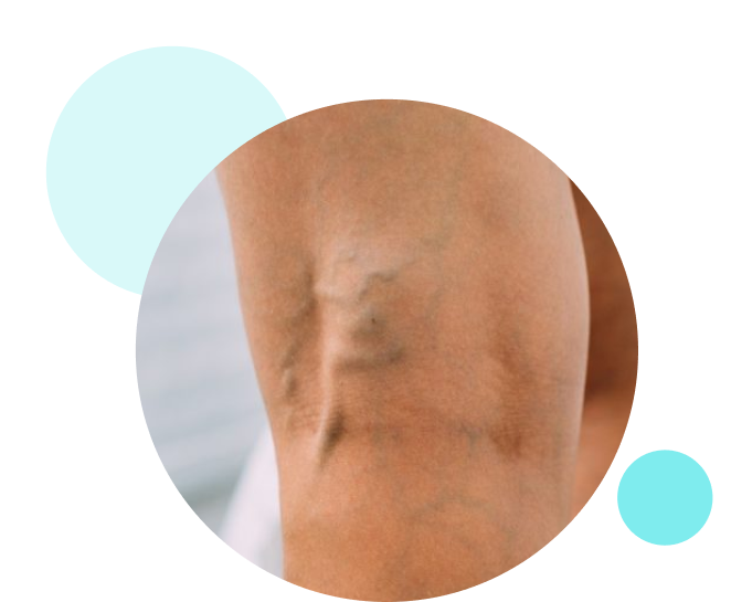 clarivein varicose vein treatment
