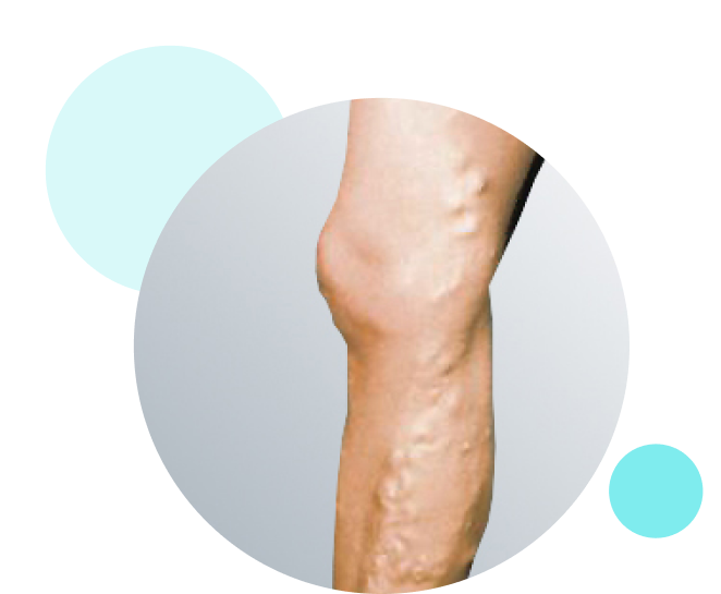 laser ablation treatment