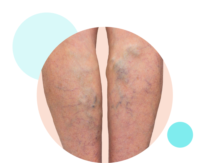 phlebectomy clinic