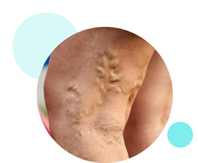 radiofrequency ablation in New Jersey
