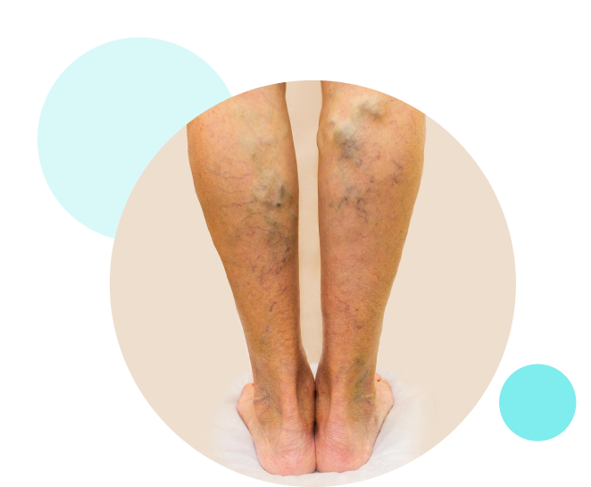venaseal treatment for varicose veins