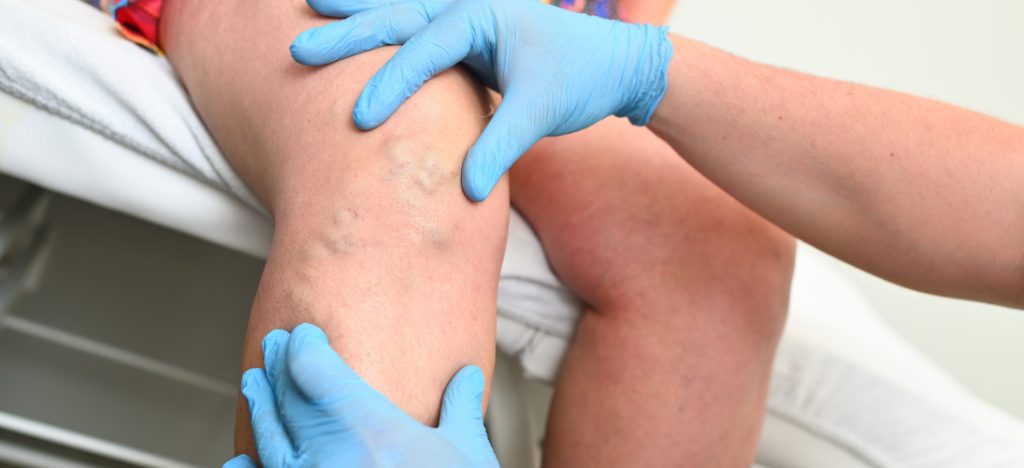 Early Symptoms And Warning Signs Of Varicose Veins