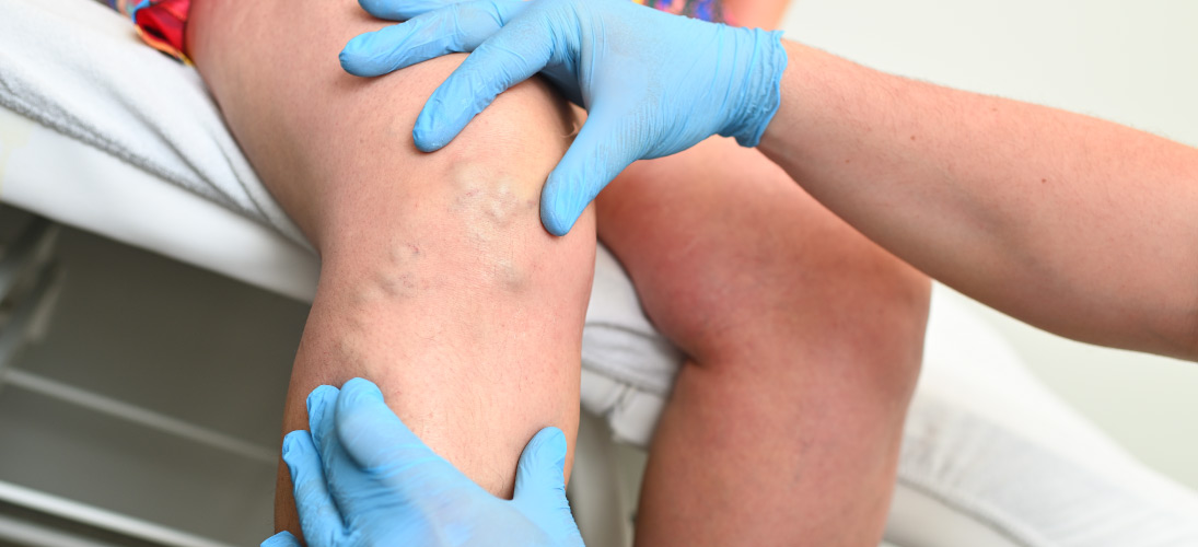 varicose veins symptoms