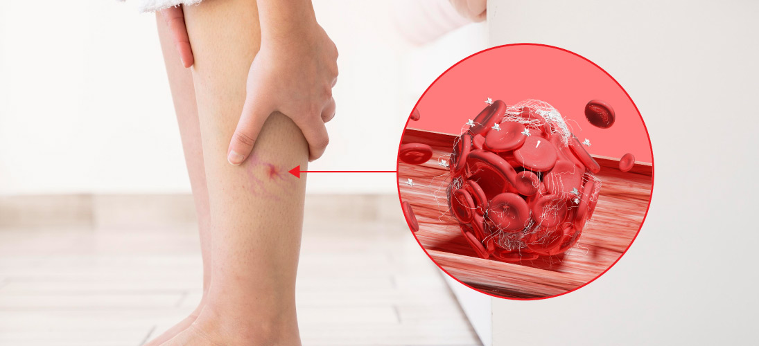 Reverse Venous Insufficiency