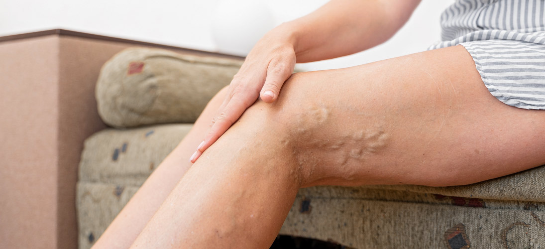 spider vein treatment cost