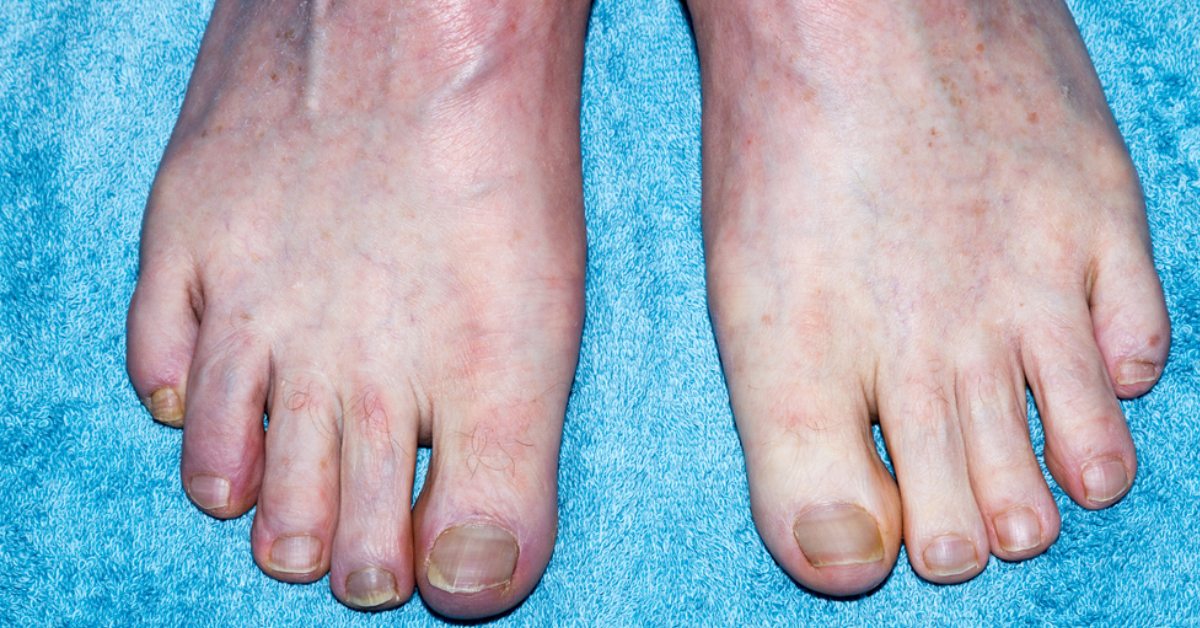 Can peripheral artery disease be reversed