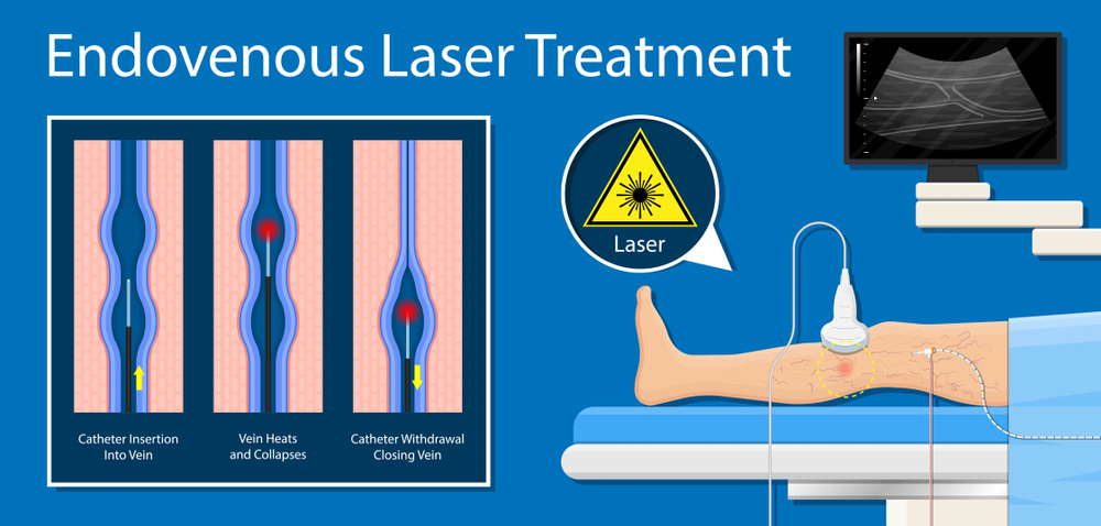 Endovenous laser varicose vein surgery treatment