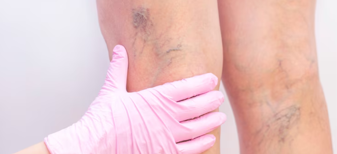 Varicose veins treatments