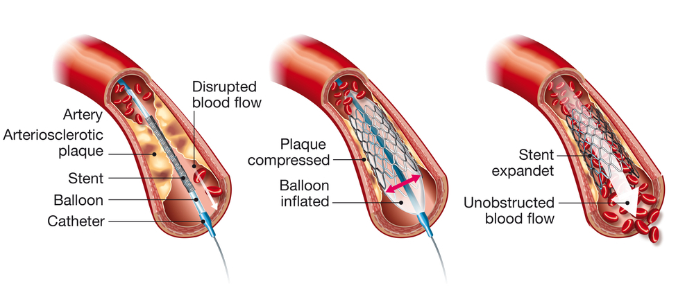 Angioplasty Cost Based On Several Stages