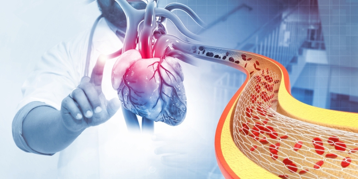 angioplasty cost