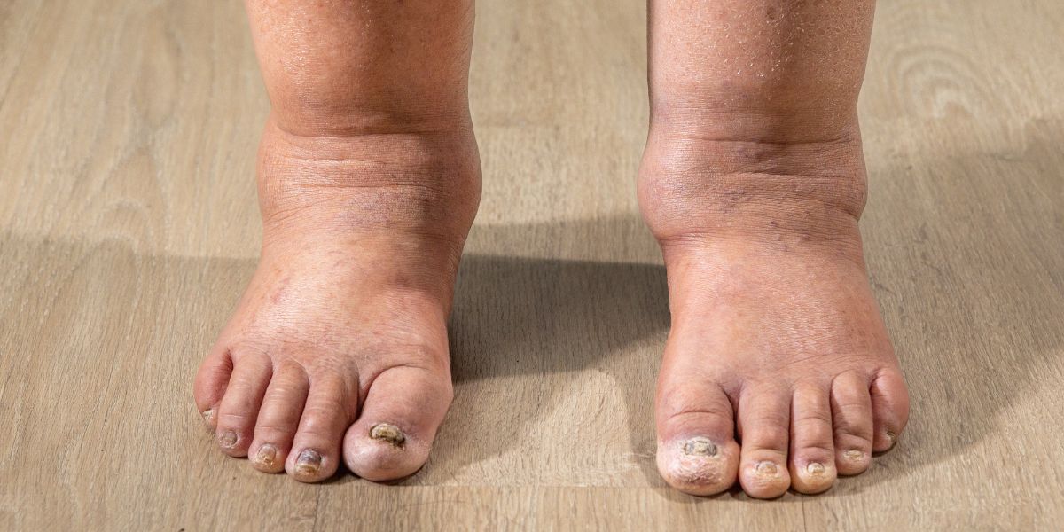 Stages of varicose vein - Ankle Change