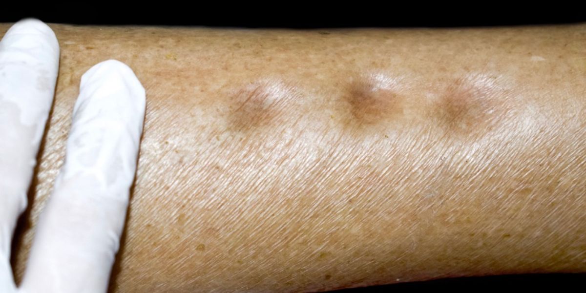 Stages of varicose vein - Edema