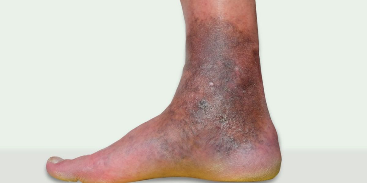 Stages of varicose vein - Skin change