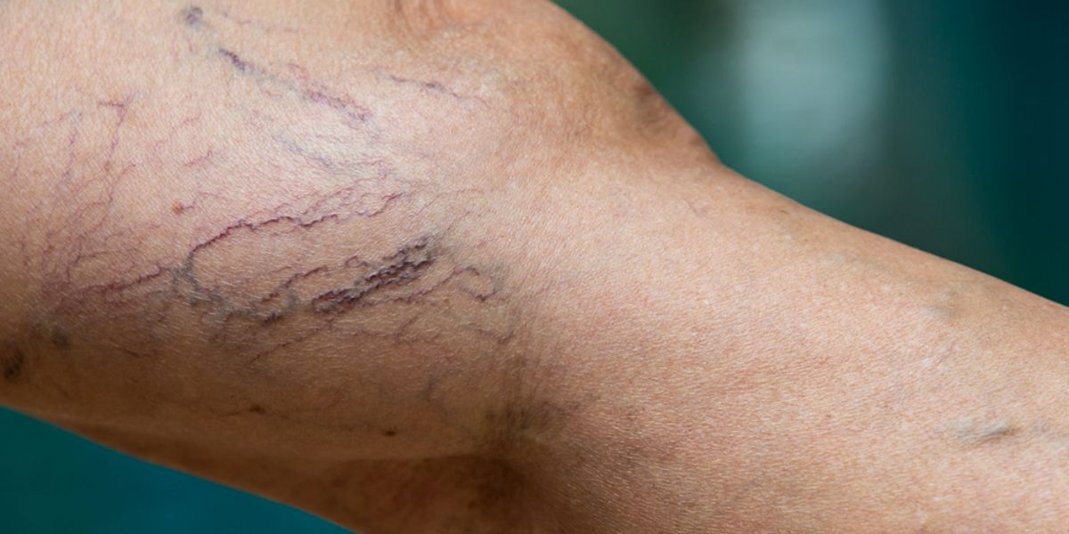 Stages of varicose vein - Spider vein