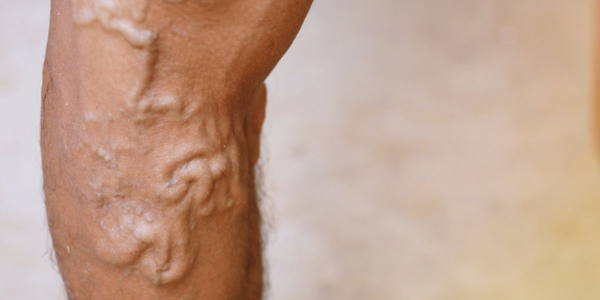 Stages of varicose vein - Swollen Veins
