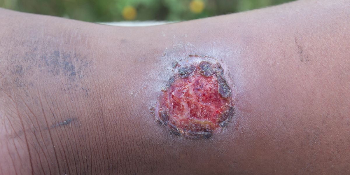 Stages of varicose vein - Ulcers