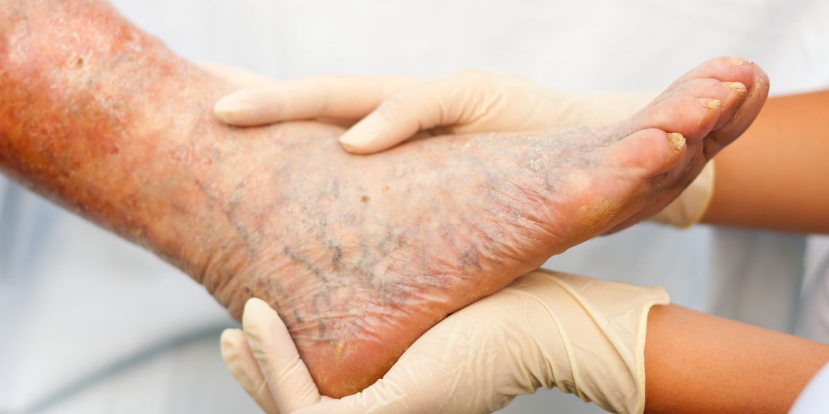 Stages of varicose vein