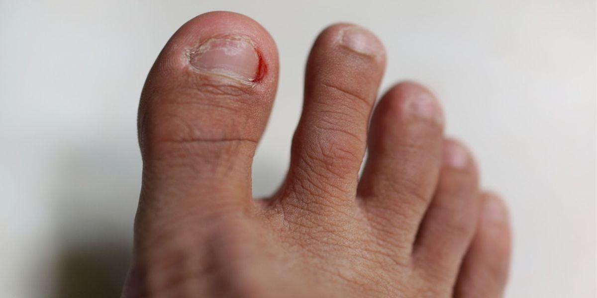 Podiatrist for ingrown toenail