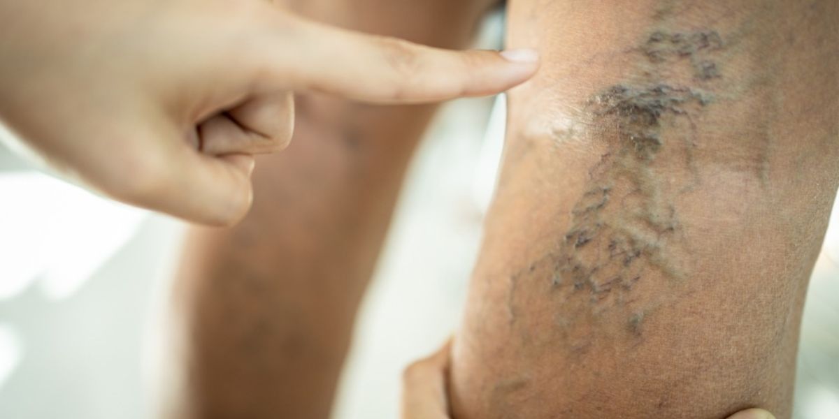What Kind Of Doctor Treats Venous Insufficiency