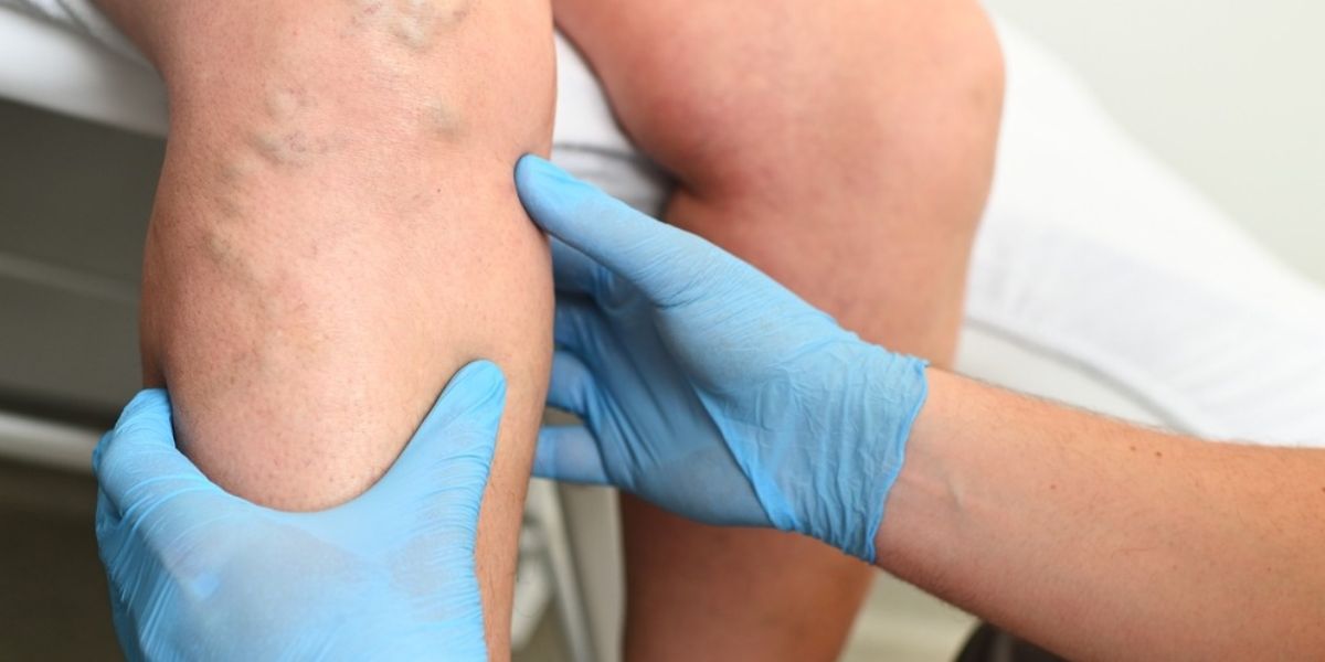What Type Of Doctor Treats Venous Insufficiency