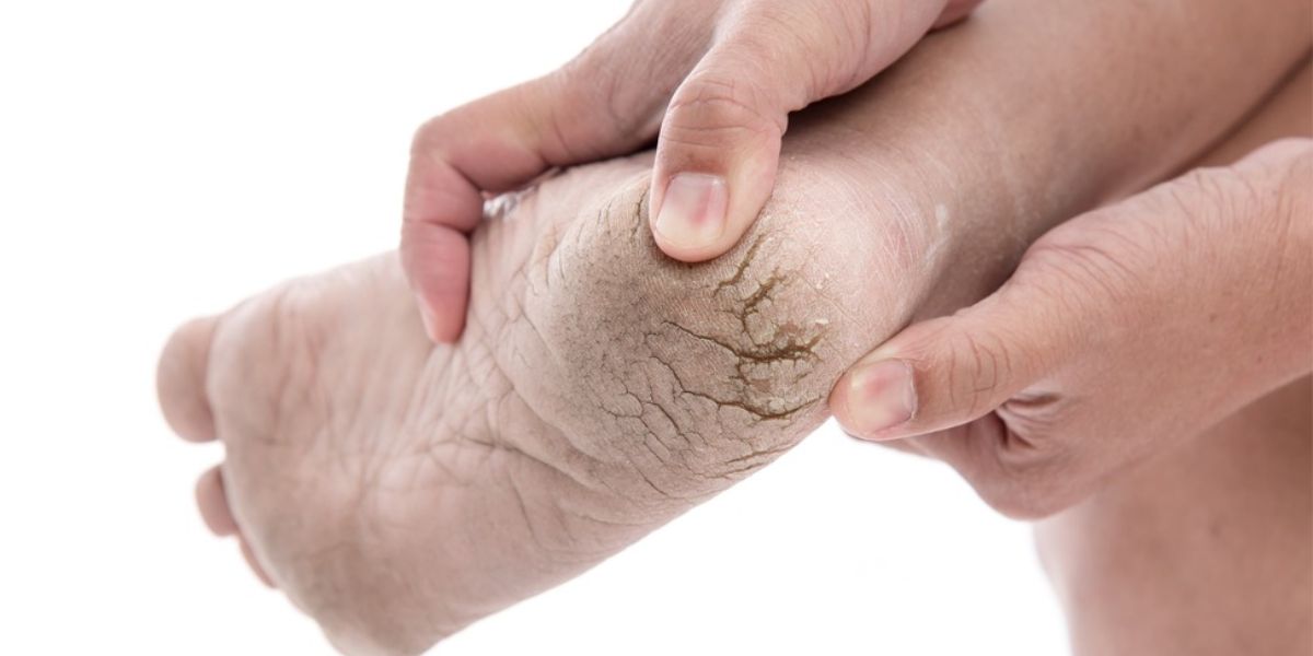 podiatrist for cracked heels