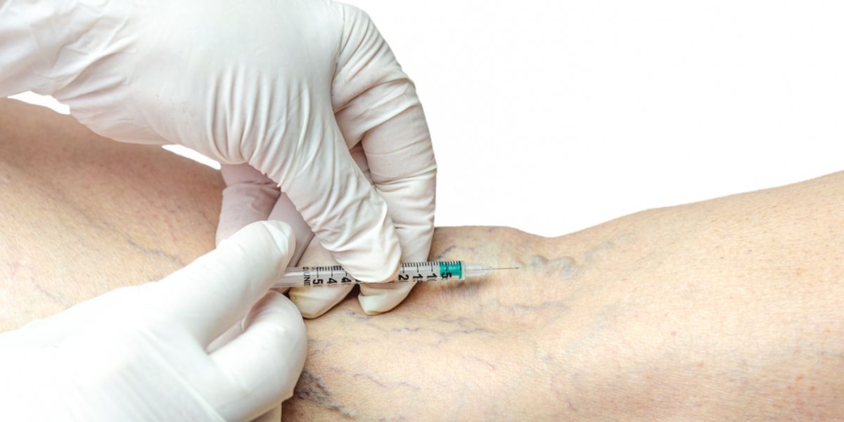 sclerotherapy price