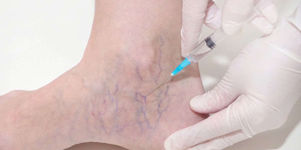 sclerotherapy cost