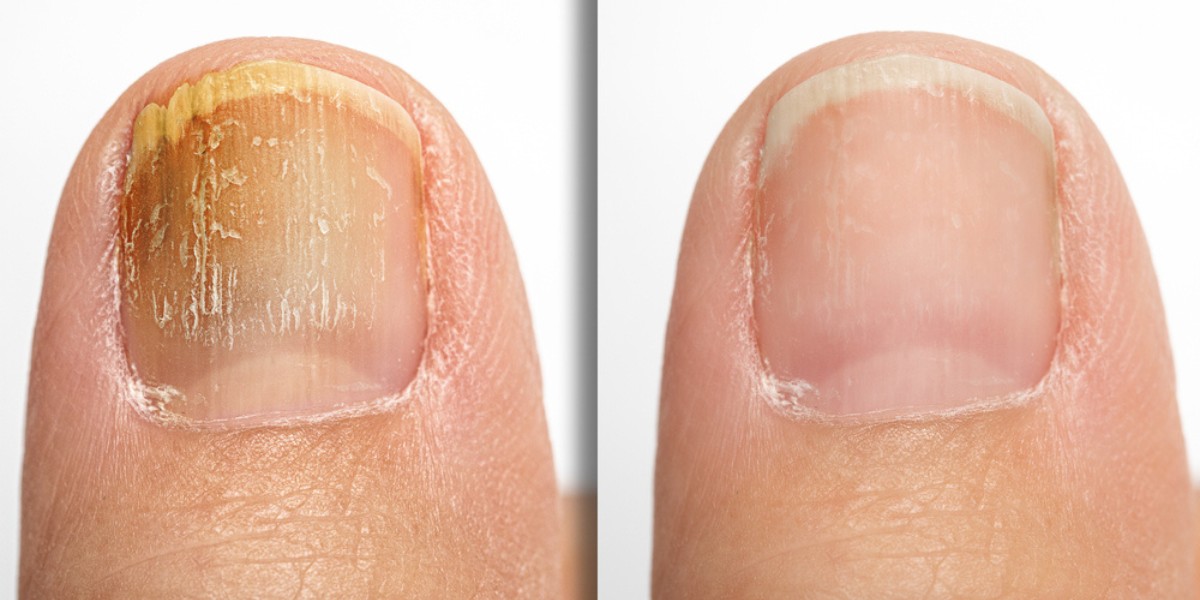how do podiatrist treat foot fungus