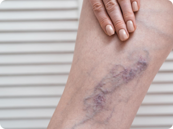 Varicose Vein Treatment