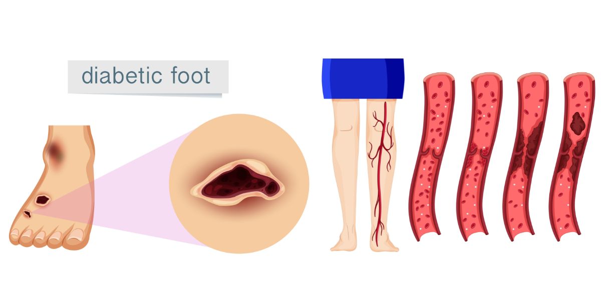 connection between diabetes and PAD