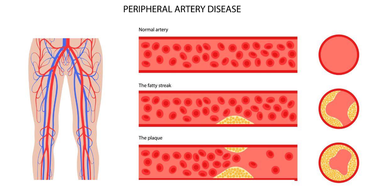 PAD artery