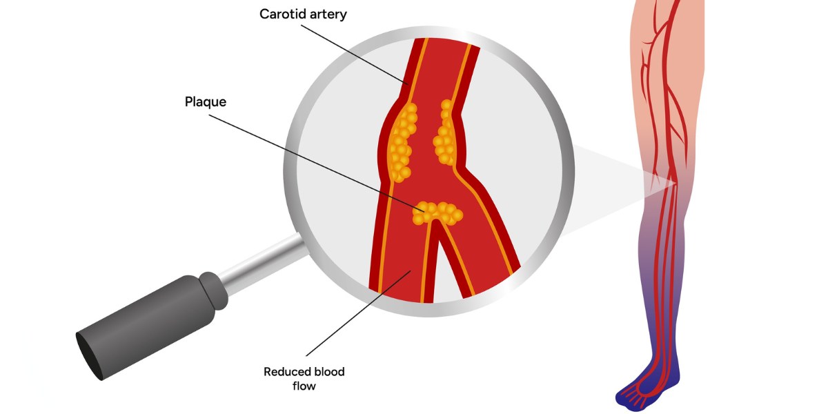 types of peripheral artery disease