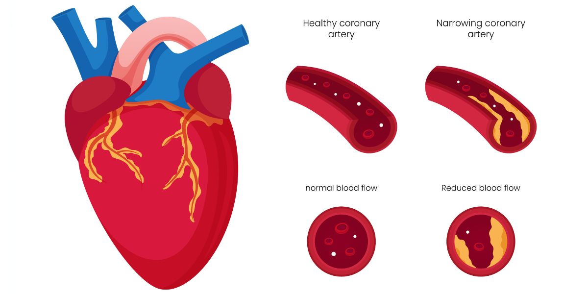 Coronary Artery Disease CAD